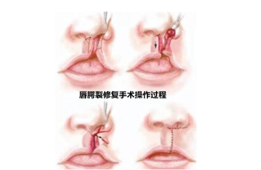 唇腭裂修复