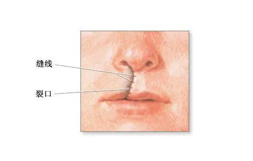 上海市九院唇腭裂修复技术