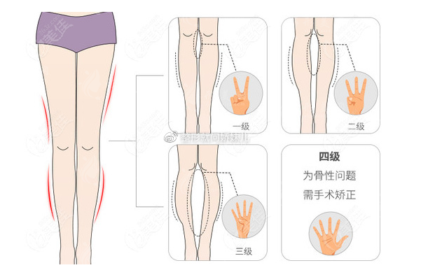 北京樱桃医疗美容腿部吸脂怎么样？做腿部吸脂/直腿术很可靠