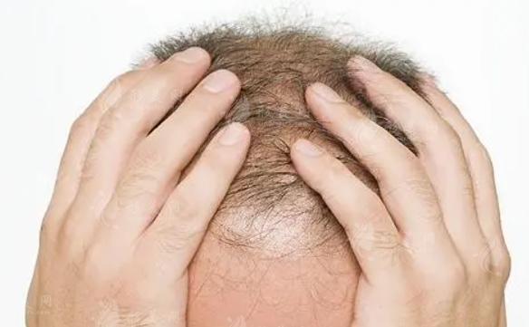 毛发移植：疼痛真相与头痛的潜在原因