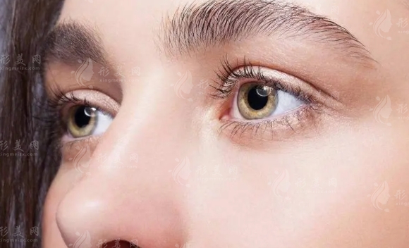 探究肿泡眼为何不适合传统双眼皮手术