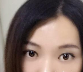 北京凯润婷医疗美容医院赵洋医生嫩肤案例：我的彩光嫩肤历程 - 珍美网