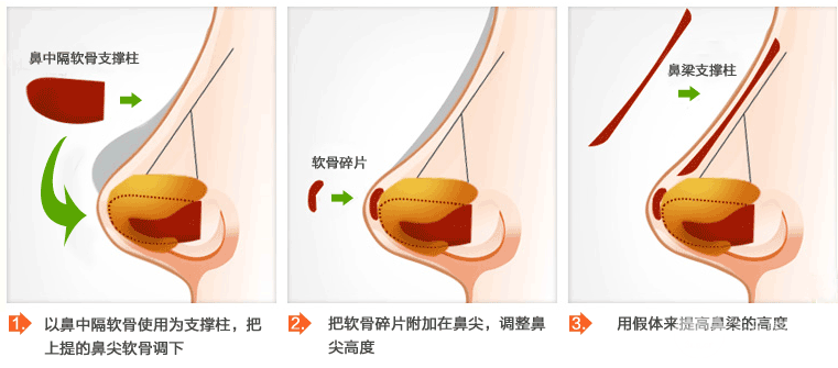 成都玉之光双眼皮、隆鼻多少钱？