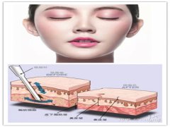 面部吸脂_面部吸脂后多久见效果？