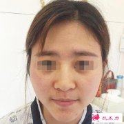 在昆明美立方医疗美容医院做完膨体隆鼻后 颜值跟气质发生了很大