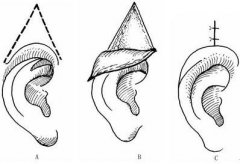 做耳部缺陷整形之后效果好吗?