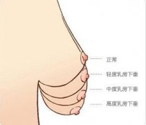 乳房下垂程度了解？