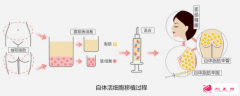 自体脂肪填充面部有硬结怎么办?