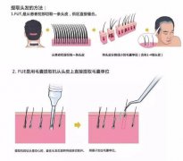 毛发移植美容术过后生存率是多少？