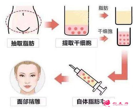 自体脂肪填充面部要注射几次才有效果