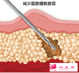 面部吸脂的危害可能有哪些