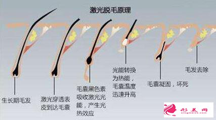 激光脱毛会有哪些并发症