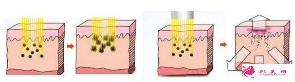 激光祛斑一星期后反黑是怎么回事