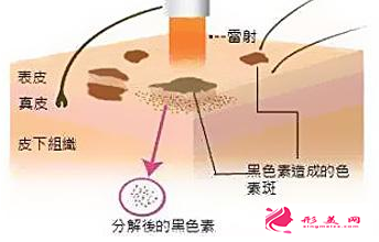 激光祛斑后结痂多久脱落