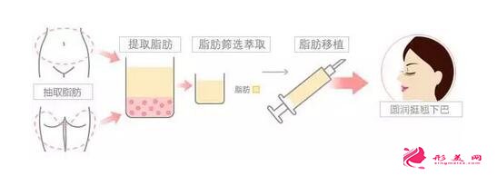 垫下巴多少钱