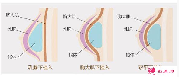 乳房植入.jpg