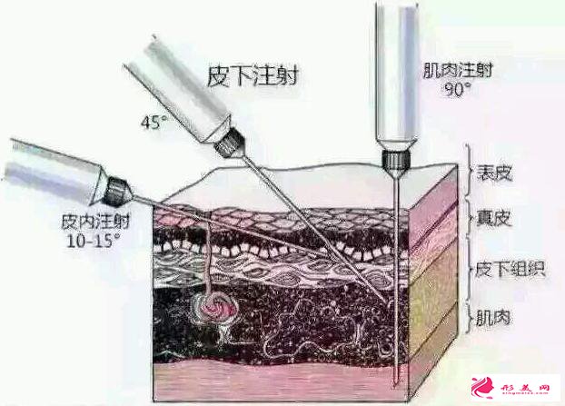 玻尿酸填充的风险