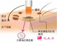 怀孕可以做激光祛黄褐斑吗？