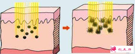 激光祛斑后皮肤会不会变薄