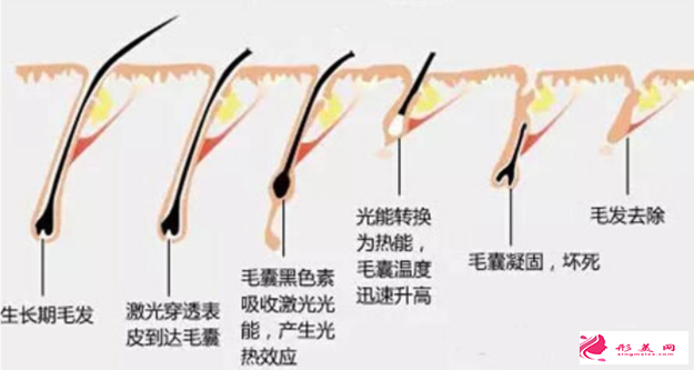 激光脱毛效果能保持多久