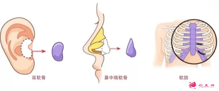 自体软骨隆鼻后能抽烟吗