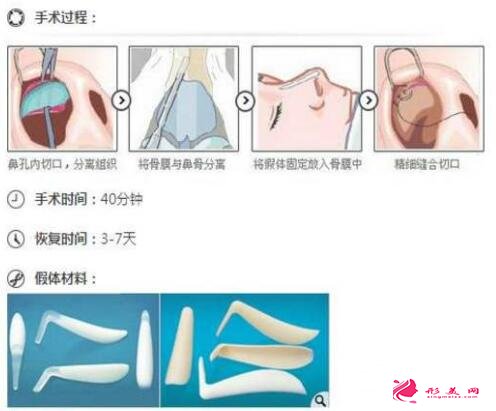 硅胶隆鼻手术的原理是啥?