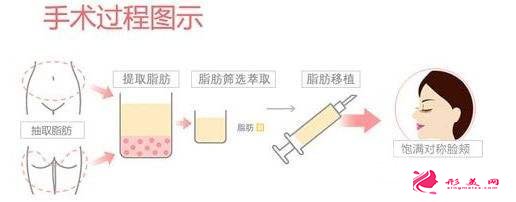 全面部自体脂肪填充大概需要多少钱？