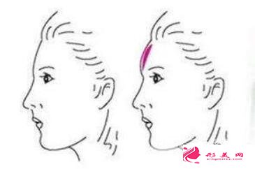 丰额头有几种方法 假体填充额头效果怎么样