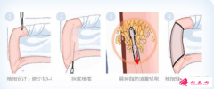 大腿吸脂要注意哪些问题？