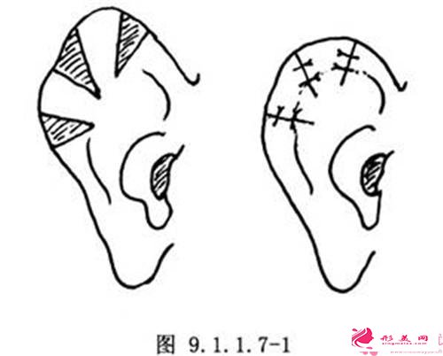 扇风耳的治疗价钱需上万元吗