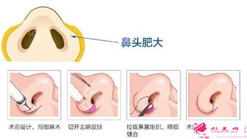 鼻翼缩小手术流程和疤痕护理