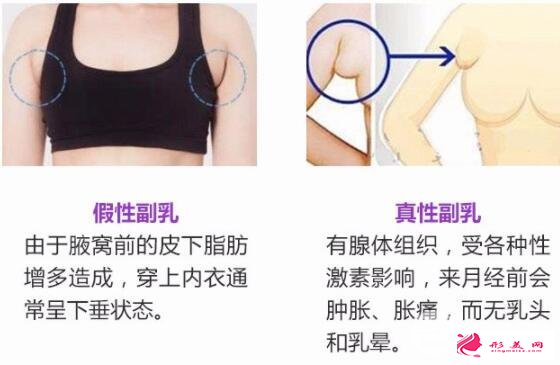 副乳手术需要多少钱？副乳竟然分“真假”