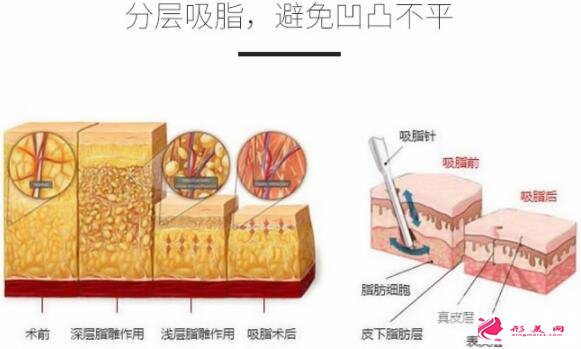 背部吸脂多少钱手术优势&效果科普