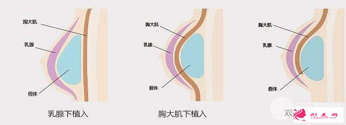 胸部整形手术多少钱？受三方面因素的影响~