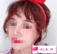 医生做的肋软骨隆鼻效果如何，进来瞧瞧吧