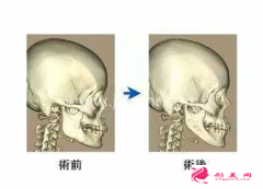 下颌角手术后会出现下垂吗?