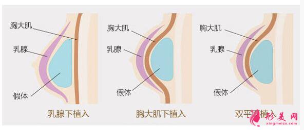 乳房植入.jpg