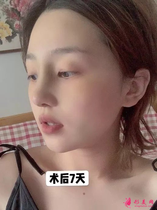 李信锋做鼻子怎么样？看看案例图就知道医生技术了