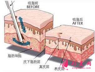 　大腿抽脂填充脸部手术风险大不大？