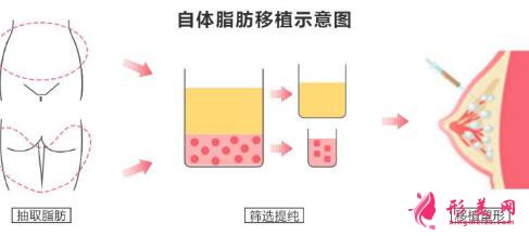 抽脂填胸多少钱?