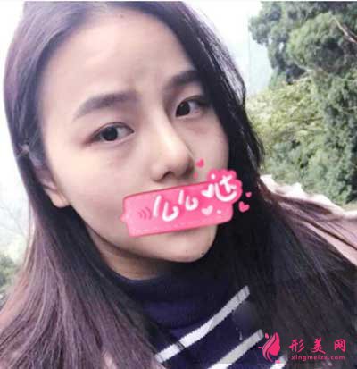 找成都华美紫馨陈杨医生做鼻综合术后20天