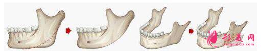 削骨手术原理简介