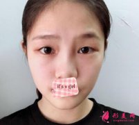 广州紫馨医疗美容医院双眼皮怎么样？双眼皮手术案例分享