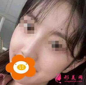 隆鼻三个月后恢复效果很好，鼻子形态自然无痕