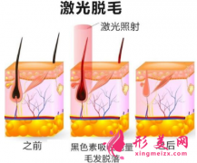 激光脱毛术前术后要注意什么？