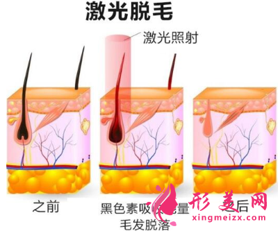 激光脱毛费用多少