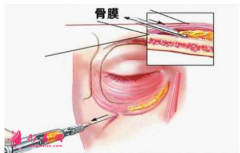 泪沟填充价格是多少？填充效果怎么样？