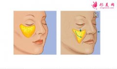 自体脂肪填充面颊价格是怎么样的？效果怎么样？