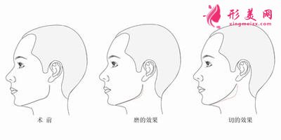 南宁下颌角切除真的可以让脸变小吗？