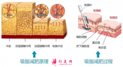 腰腹部吸脂后多少天可以上班？